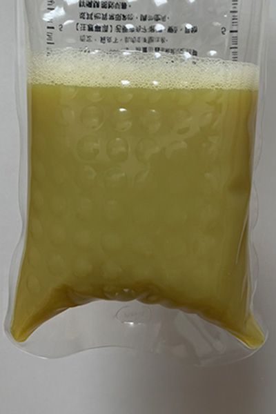 顯示血液淨化療程中處理後的廢液，呈現黃色液體與泡沫層。