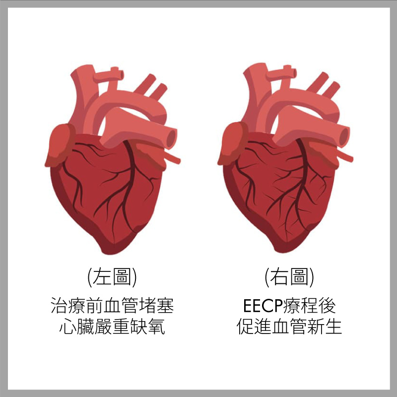 EECP體外反搏治療，改善心臟缺氧狀況，有效促進血管新生並提升心臟灌流量。